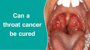 Throat cancer generally refers to cancers that start in the pharynx or larynx (voice box), but can also refer to cancers that start in the oesophagus (food pipe) or thyroid. Can A Throat Cancer Be Cured Youtube