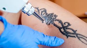 how much does tattoo removal cost