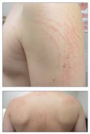 pruritic and erythematous rash