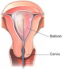 The presence of endometrium in areas other than the lining of the uterus , as on the. Thermal Balloon Endometrial Ablation Healthdirect