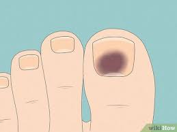 remove and care for dead toenails