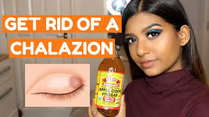 how to get rid of a chalazion fast at