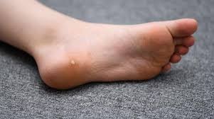 6 things to know about plantar warts