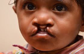 free cleft lip and palate surgery at