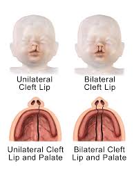 cleft lip and palate surgical repair