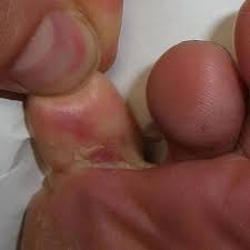 foot between toes and toenail fungus