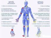 Resultado de imagen para diferencia entre artritis y artrosis