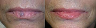 hemangioma of the lip purple spot on
