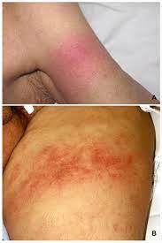 erythema oedema of the skin and soft