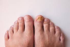 what causes toenail fungus how can it