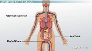 This overgrowth of tissue can cause a variety of health problems, including pelvic pain and infertility. What Is A Fistula Definition Symptoms Treatment Video Lesson Transcript Study Com