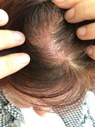 scalp caused by hair dye