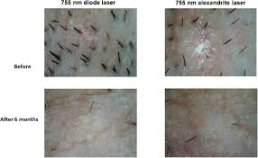 left axilla with 755 nm diode laser