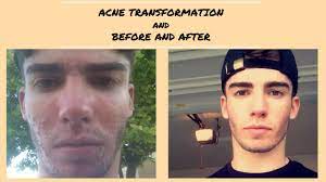 after acne cure acne caveman regimen