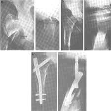 gamma nail in the treatment of closed