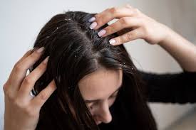 dandruff remes 3 ways to get rid of