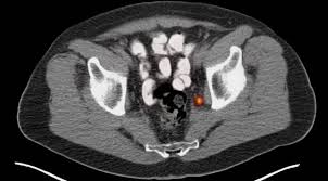 Enhanced Precision in Prostate Cancer Recurrence Prediction through PSMA PET Imaging - 1