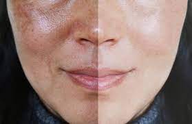what is the best melasma treatment a