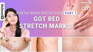 how to reduce stretch marks and prevent