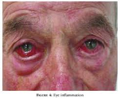 Image result for relapsing polychondritis
