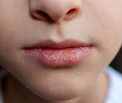 kids with dry mouth remes from