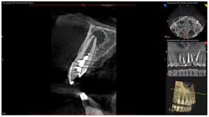 endodontic microsurgery
