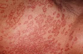 This skin condition rarely causes symptoms, such as pain or itch. Granuloma Annulare Causes Rash Treatment