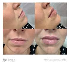 lip augmentation premier clinic