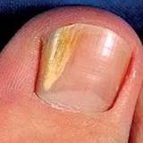 fungal nails why does the underside of