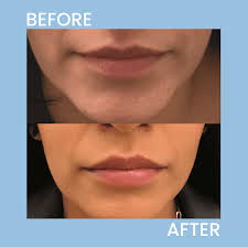 lip fillers photos pricing new