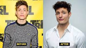 Matt Rife Plastic Surgery & Weight Loss. Glow Up And Before After Pictures.