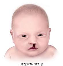 the facts about cleft lip and palate