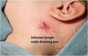 lymph node in children dr joann child
