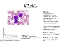 Myeloid Malignancy Overview