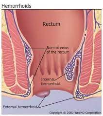 Hemorrhoids are the most common diseases of the rectum. Hemorrhoids Internal External Pictures Symptoms Causes Treatment