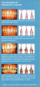 Gum Disease Annapolis Md Gingivitis Periodontal Disease