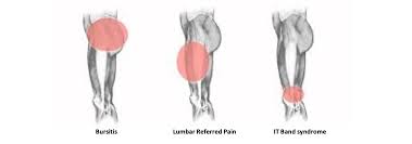 diagnosing lateral thigh pain it band