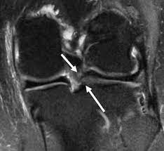 lateral meniscus tear complex knee