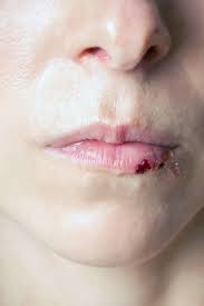 split lip causes treatments and home