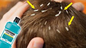 get rid of head lice with only one