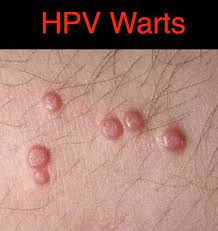 hpv warts ointment 4 oz 118 ml with