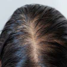 causes thinning hair