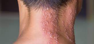 shingles herpes zoster dermatology