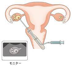 卵子の採り方、精子の採り方（採卵・採精） | おち夢クリニック名古屋 - 不妊治療（体外受精）