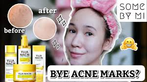 Regardless if i pick at my acne or not, i will get a scar and it sucks. Effective Pangtangal Ng Acne Marks Blemishes Some By Mi Yuja Niacin Review Youtube