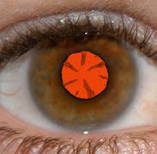 Abnormal Red Reflex In Patient With Cortical Cataract