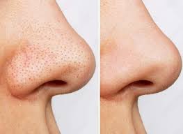 get rid of blackheads on the nose