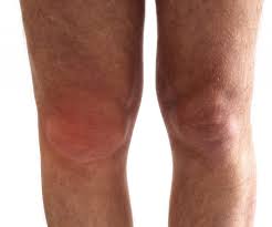 knee synovitis and inflammation