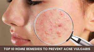 home remes to prevent acne vulgaris