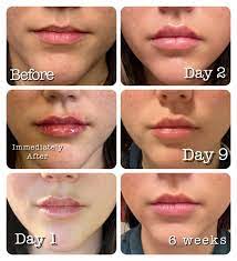 lip filler swelling ses central